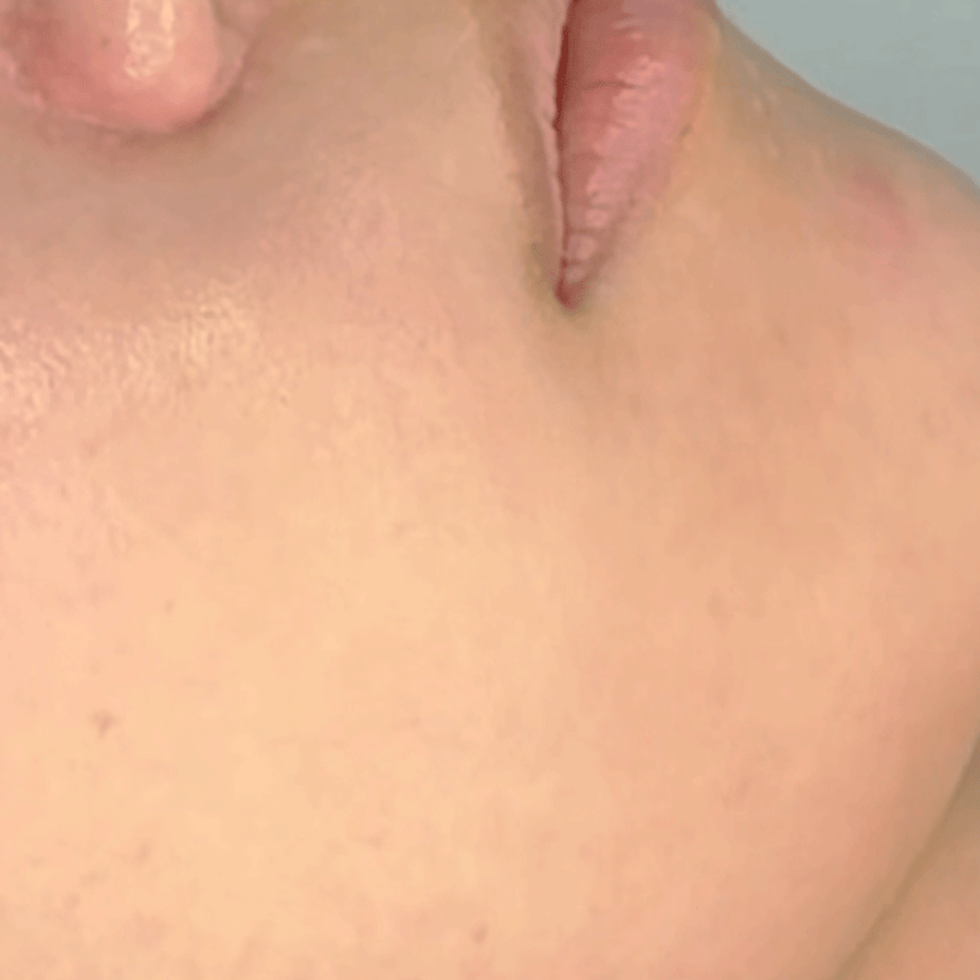 Acne, Redness & Inflammation after