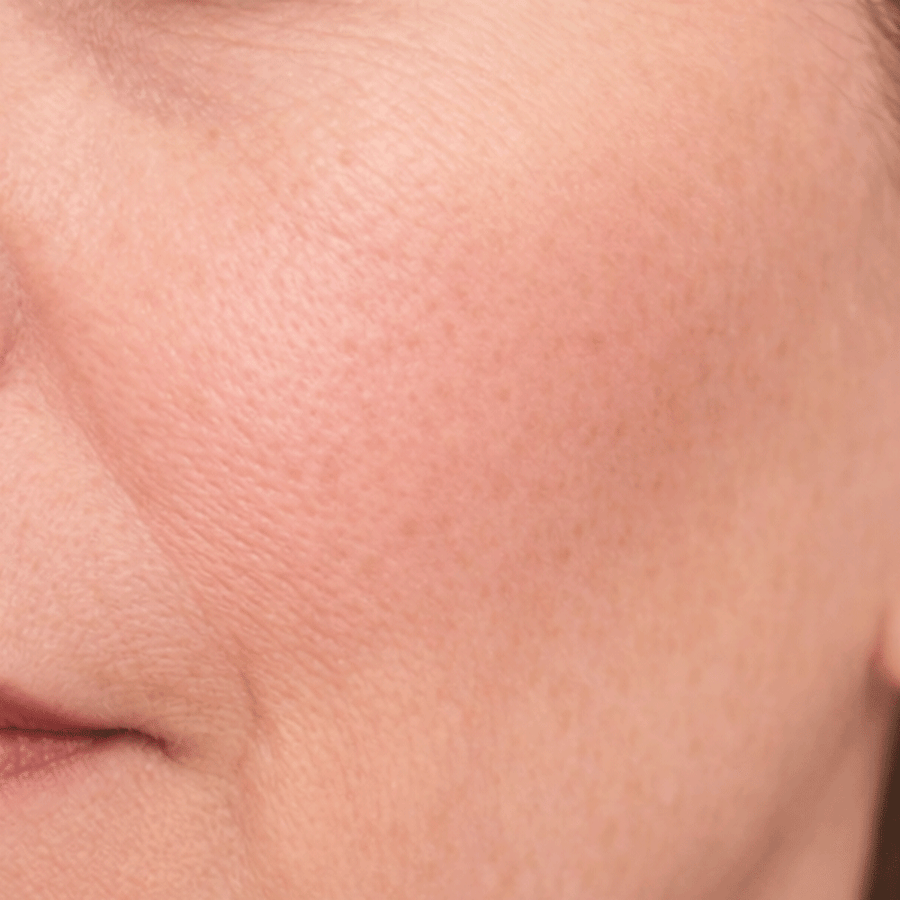 Fine Lines & Wrinkles after