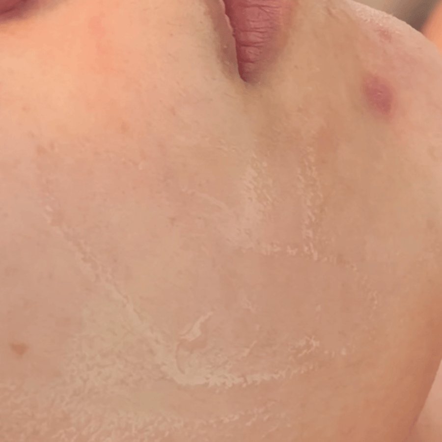 Acne, Redness & Inflammation before