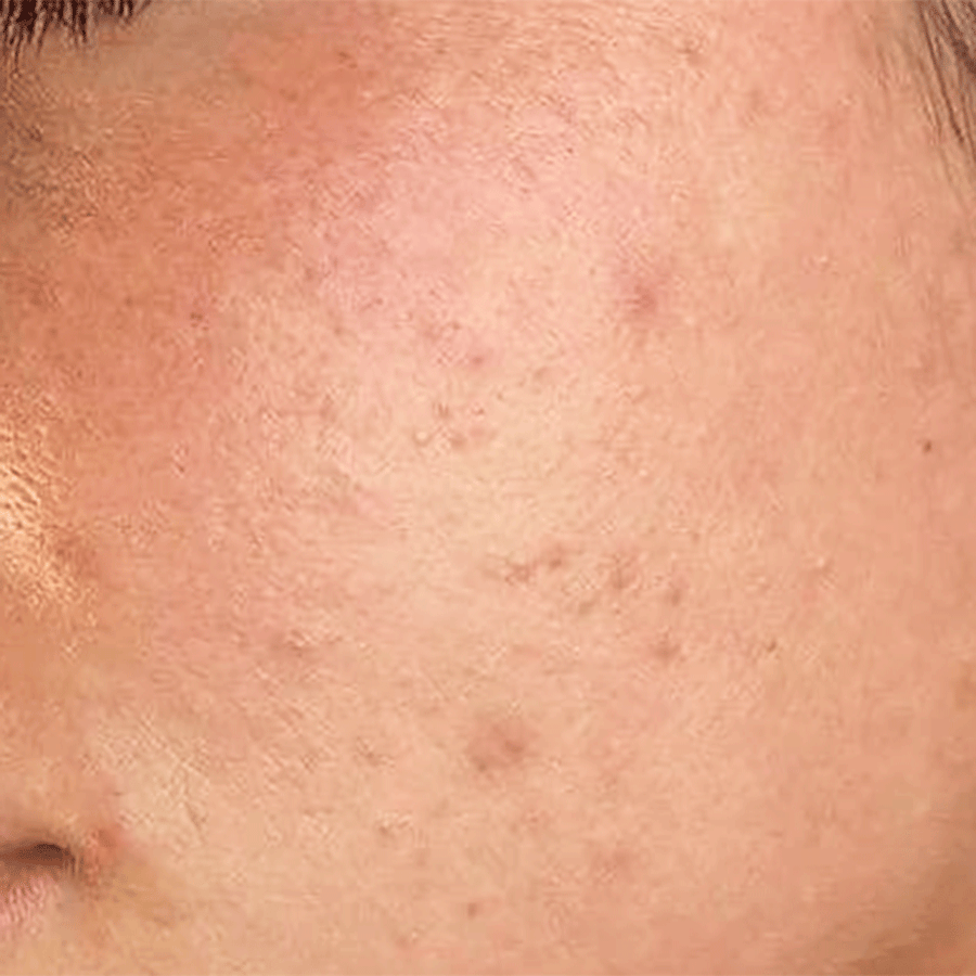 Firmness & Elasticity before