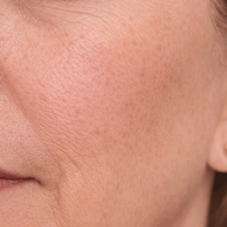 Fine Lines & Wrinkles before