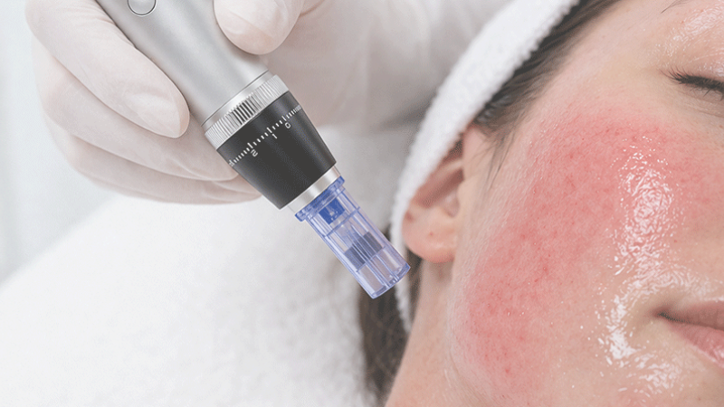 Microneedling / RF treatment